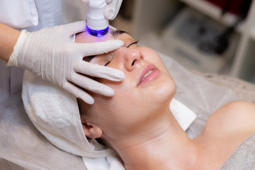 Microneedling
