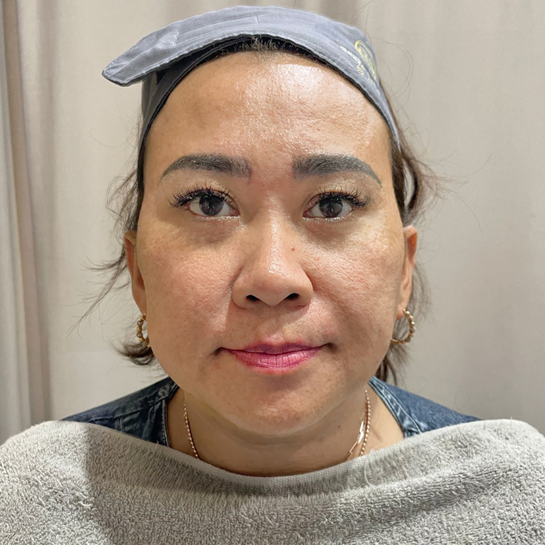 After Exion RF Microneedling