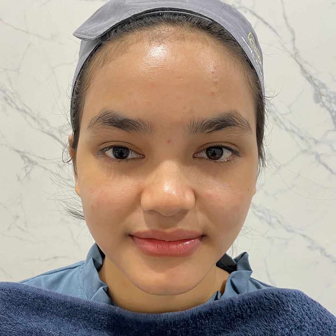 After Korean Microbubble