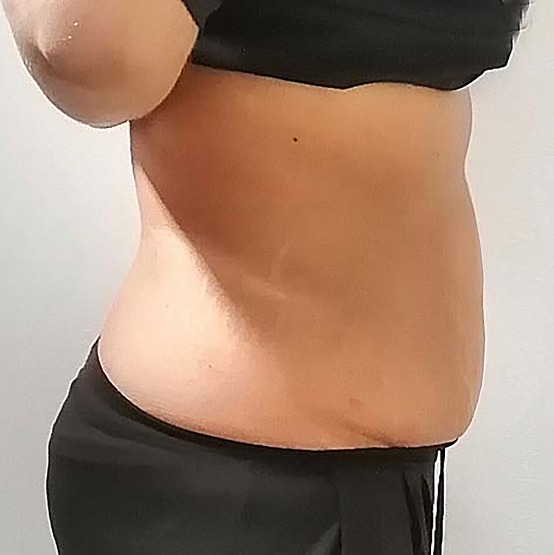 After Lippo Slimming