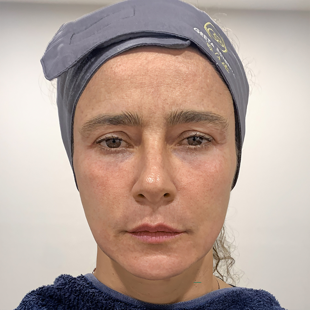 After Ultraformer MPT