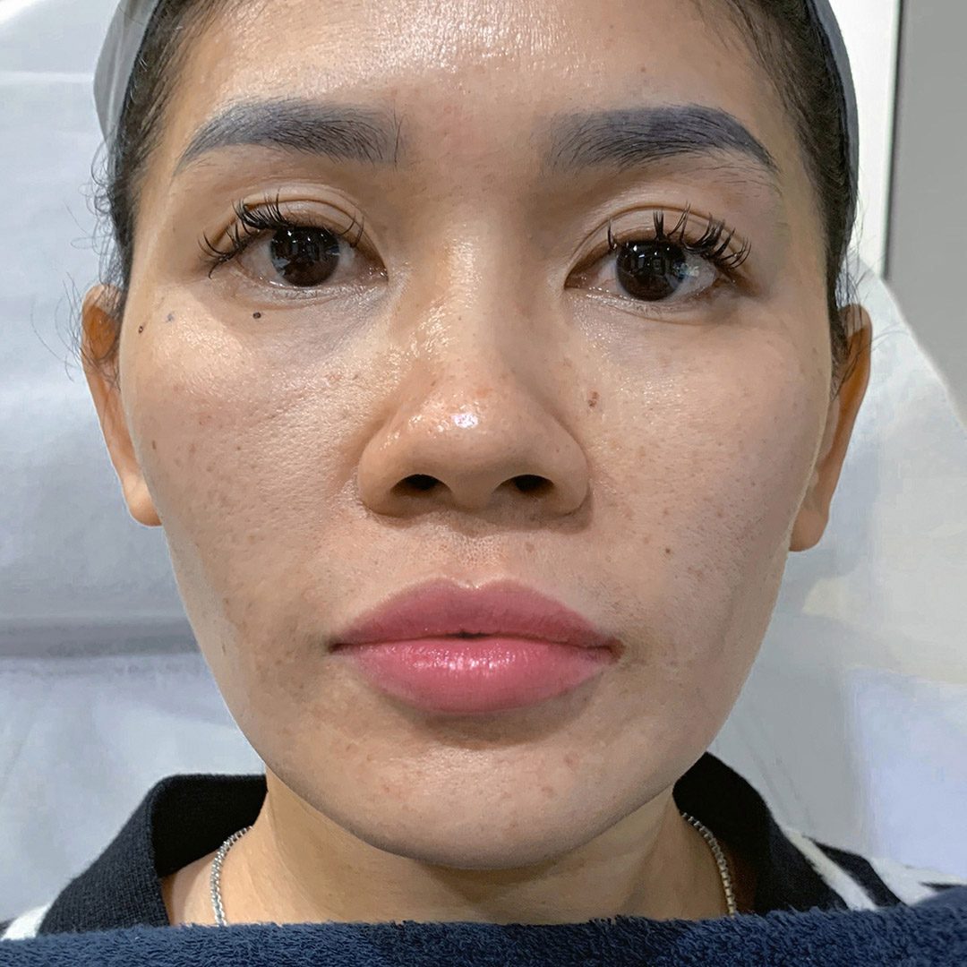 After Pink Kiss Filler