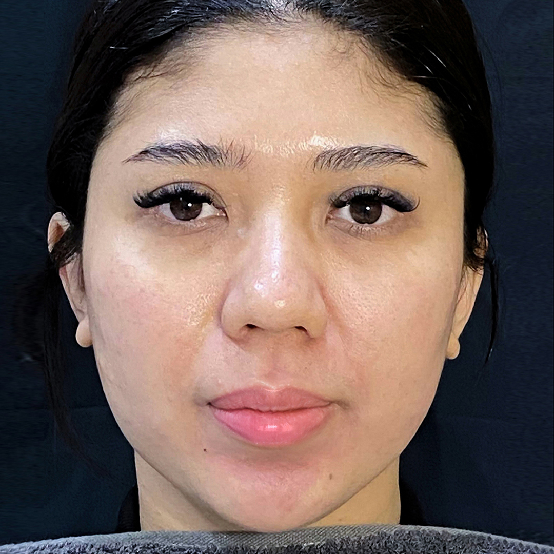 After Lips Pico Laser