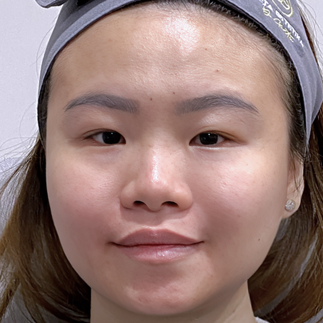 After Smile Line Filler