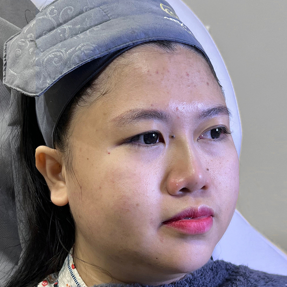 After Nose Threadlift