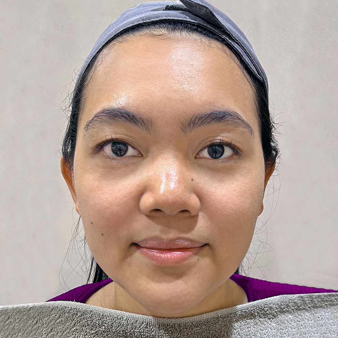 After Chemical Peeling