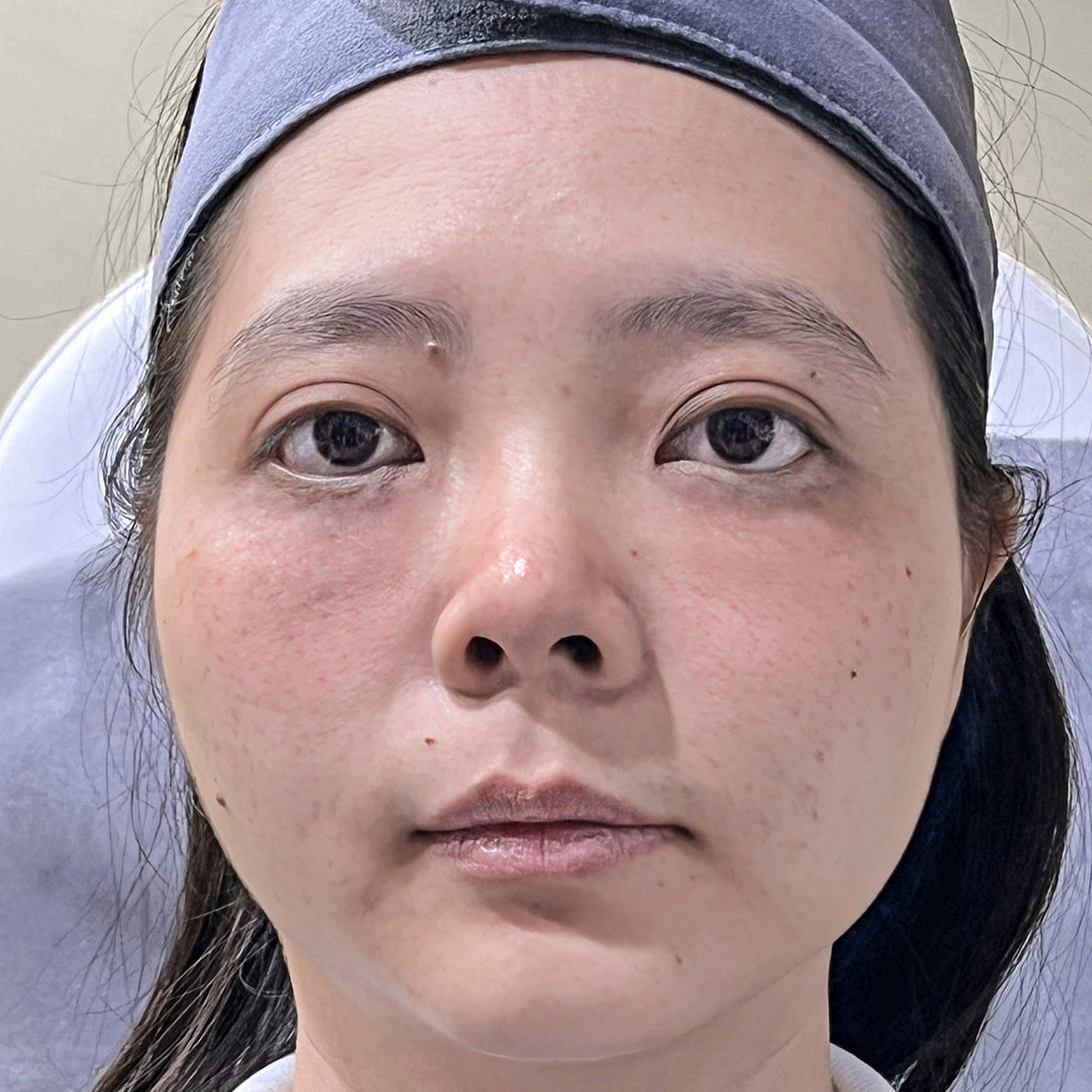 After Juvelook Under Eye