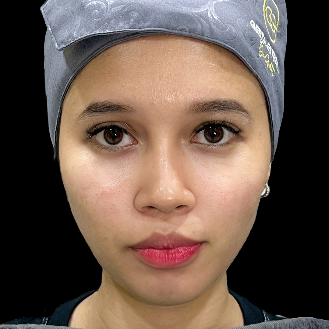 After Gold Threadlift