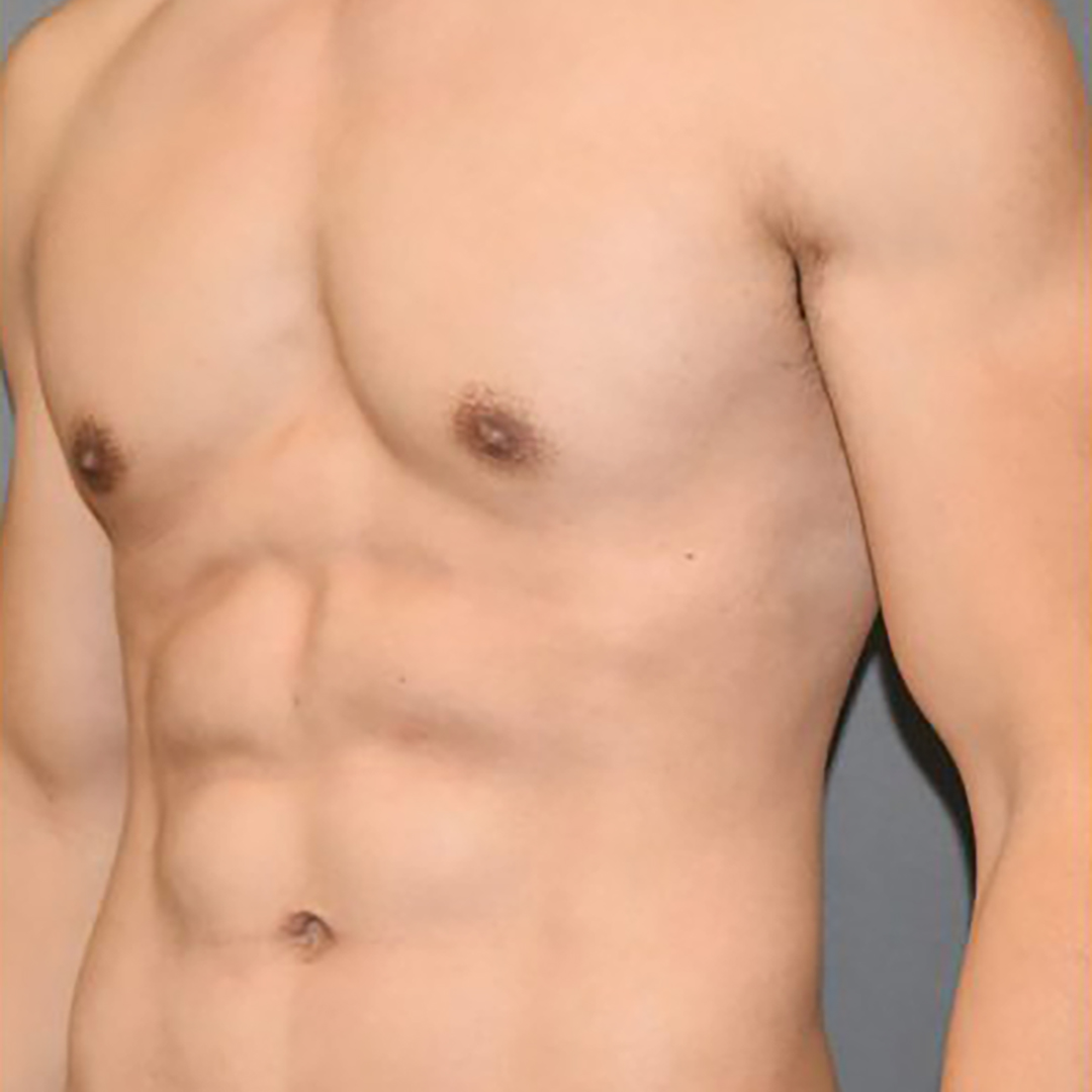 After Ultrasound Vaser Lippo Selection