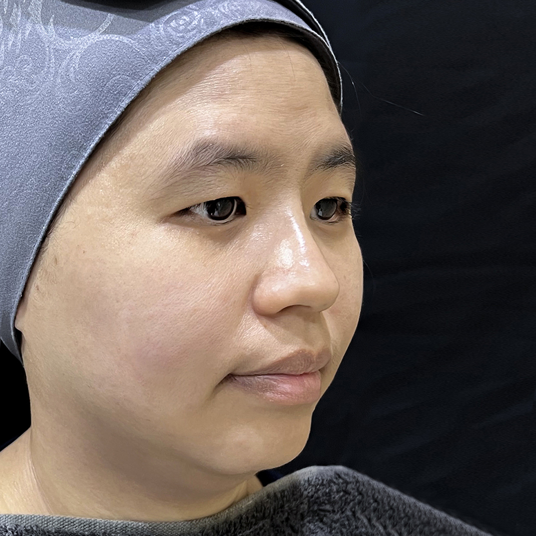 After Meso Double Chin