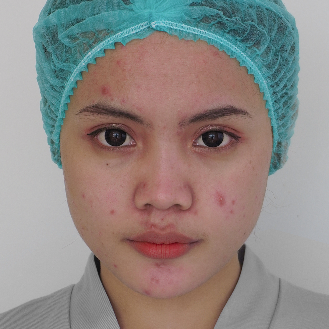 Before Exion Clear RF