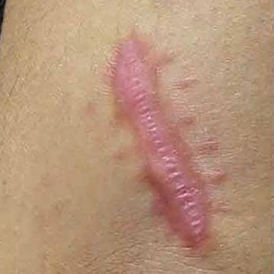 Before Suntik Keloid