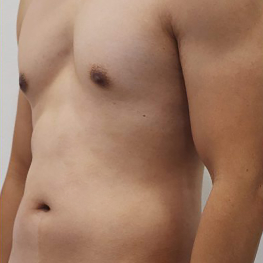 Before Ultrasound Vaser Lippo Selection