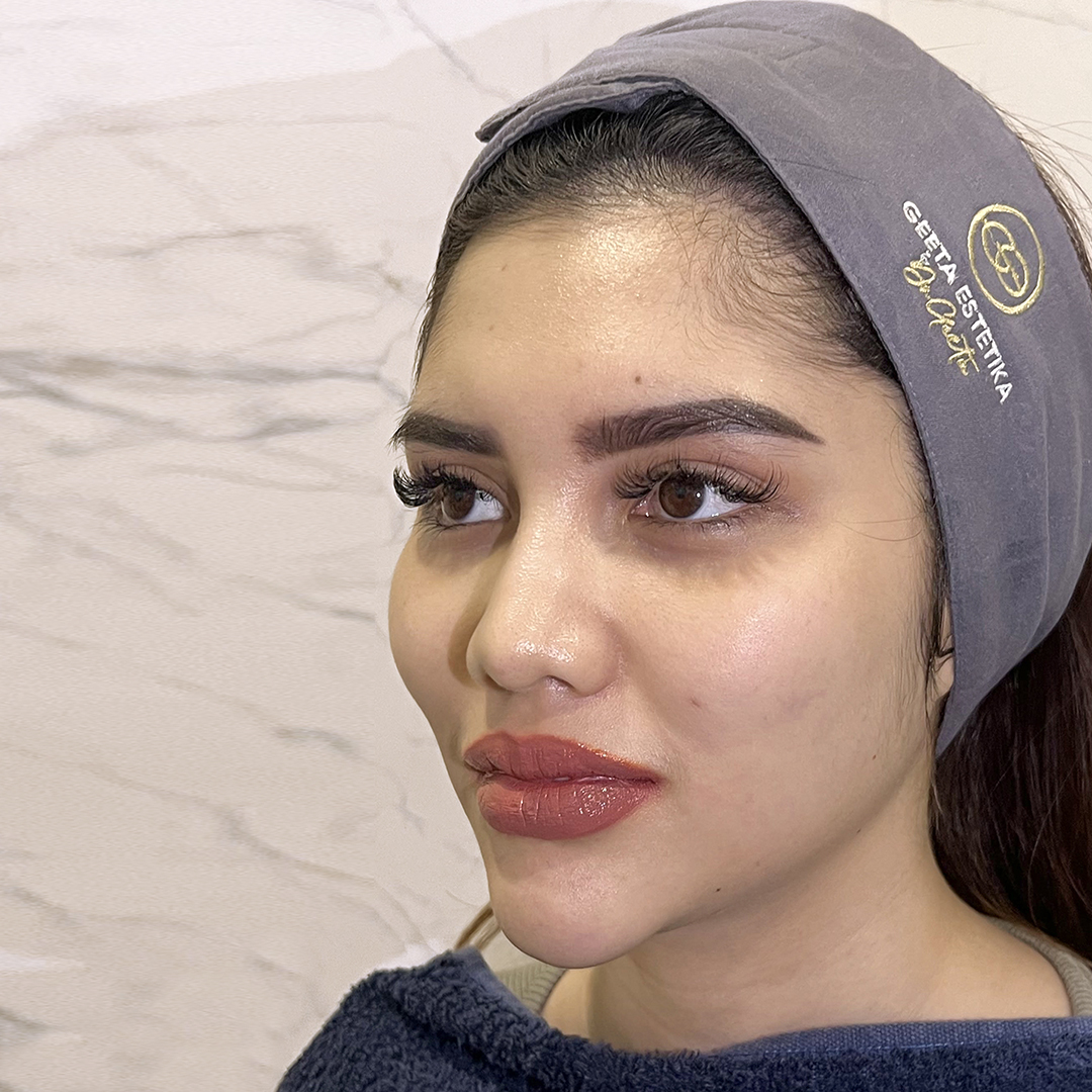 Before Ultralift 12D