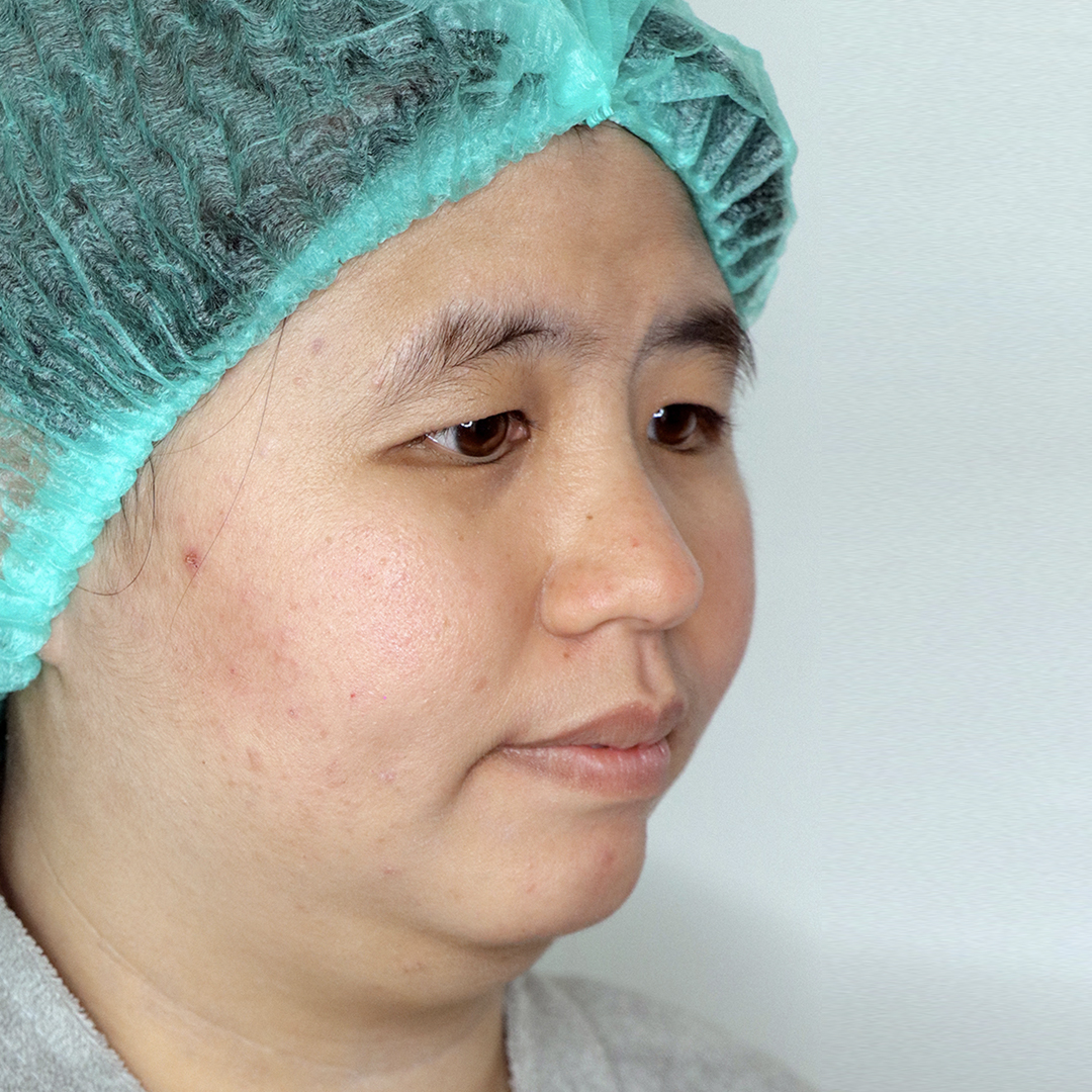 Before Meso Double Chin