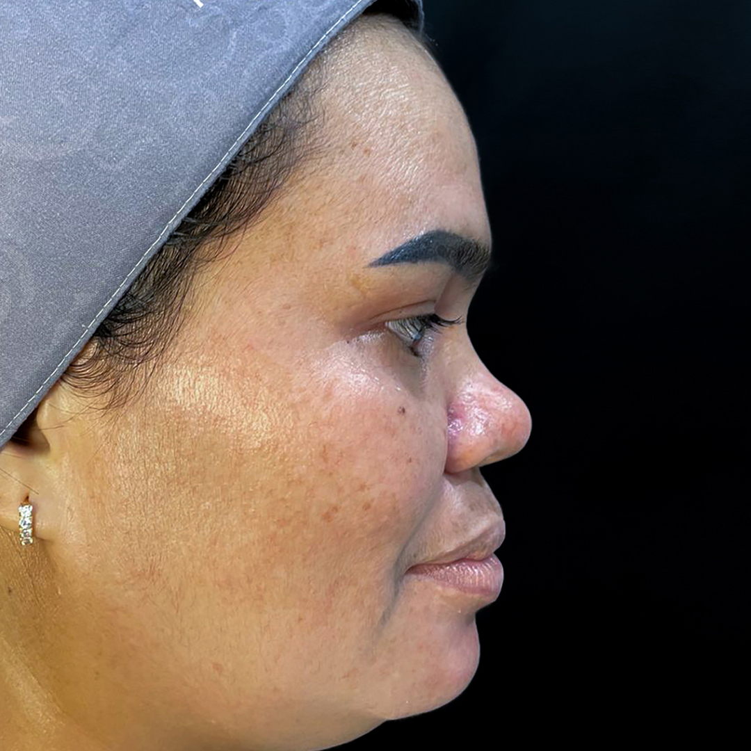 Before Filler Hidung