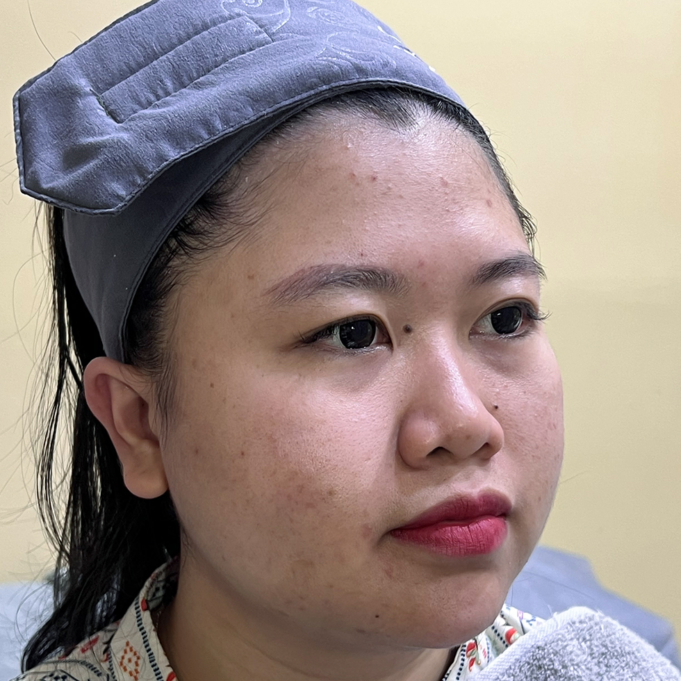 Before Nose Threadlift