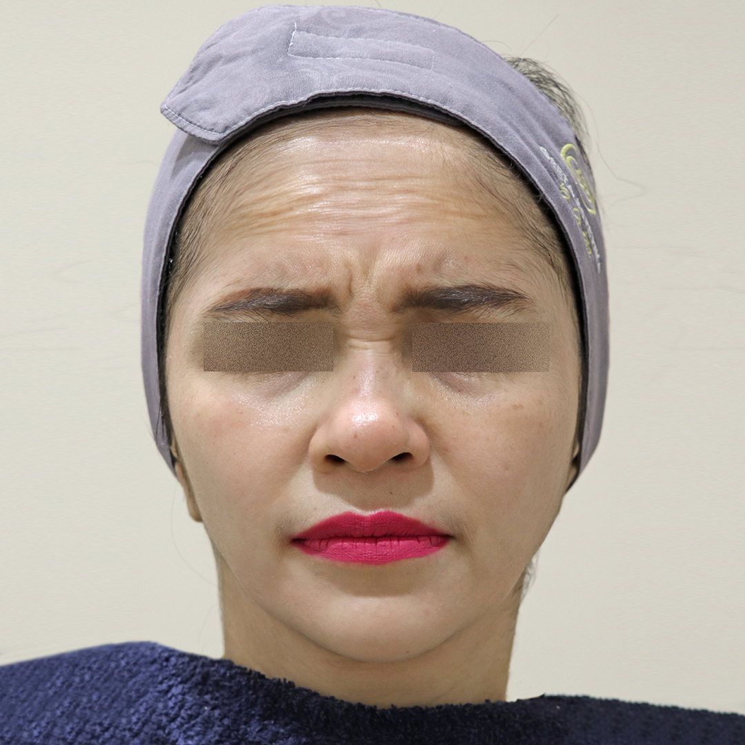 Before Botox Allergan