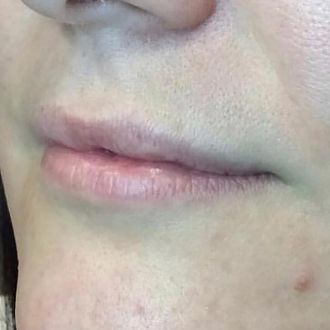 Before Lip Threadlift