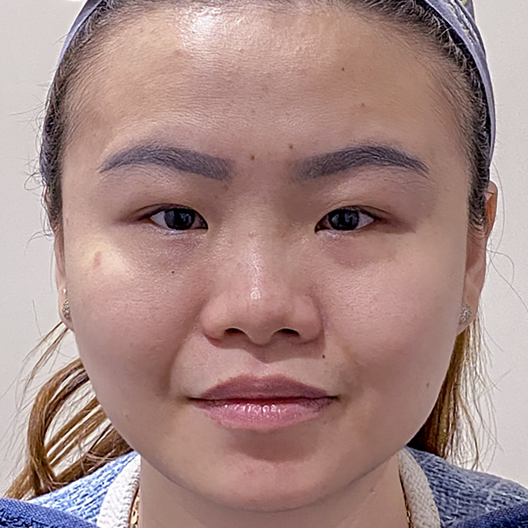 Before Smile Line Filler