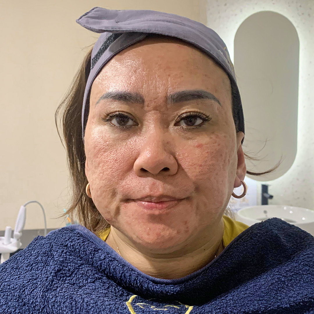 Before Exion RF Microneedling