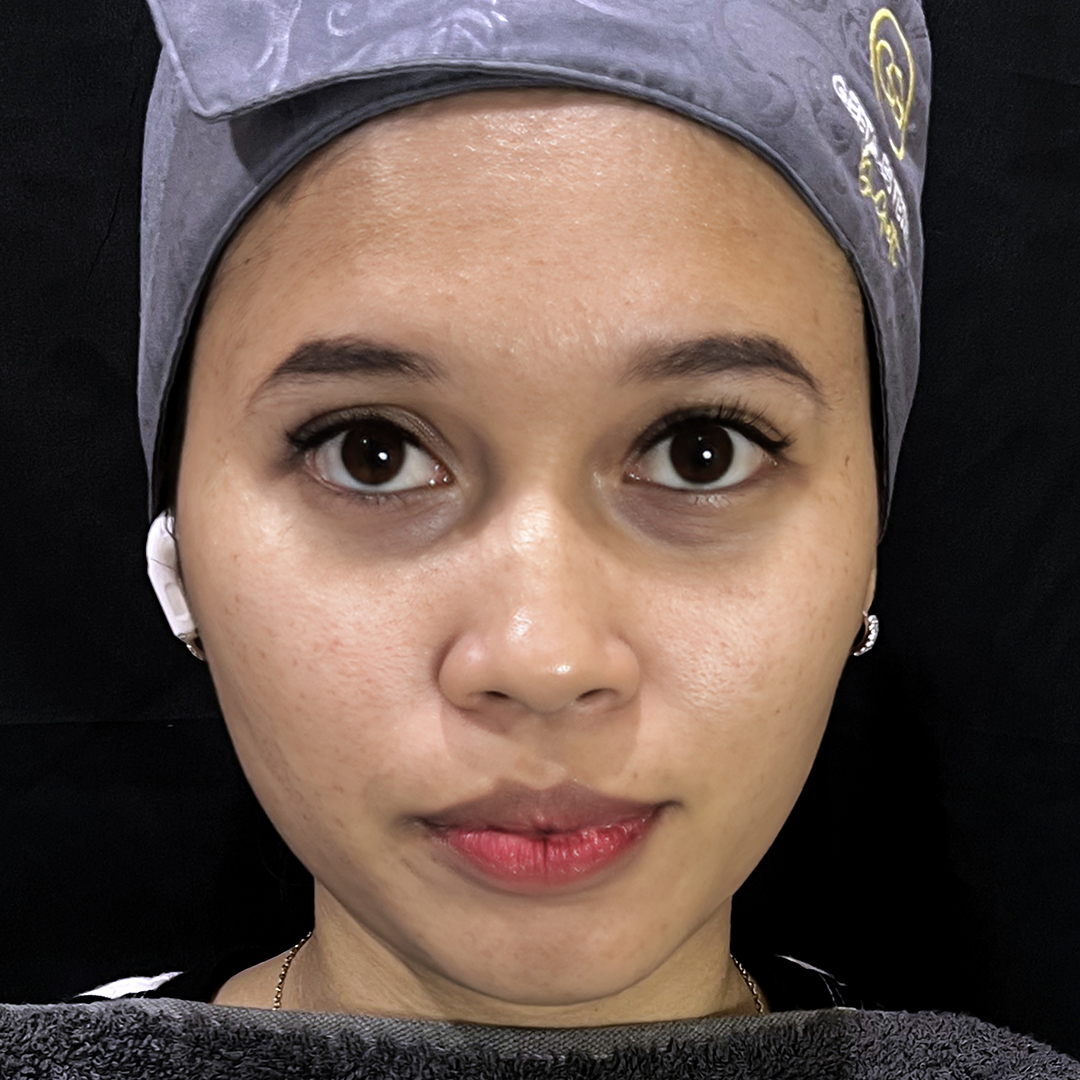 Before Gold Threadlift