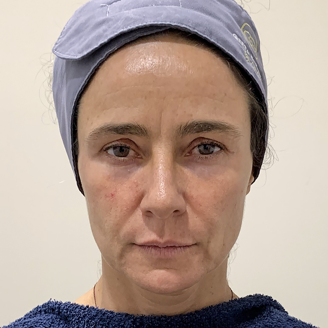 Before Ultraformer MPT