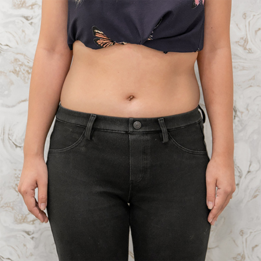 Before Fat Apoptosis