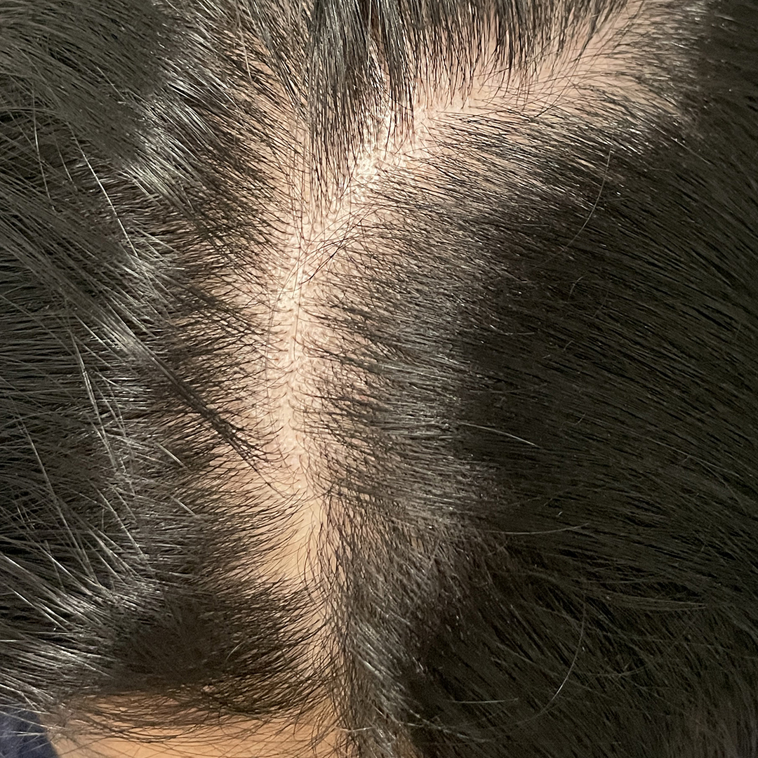 Before Micrografting hair Regeneration