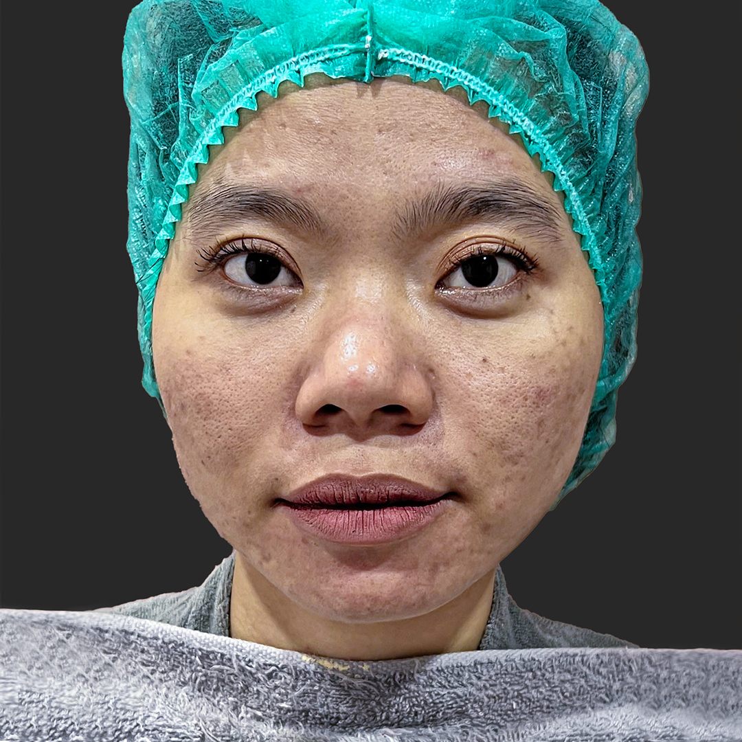 Before Growth Factor