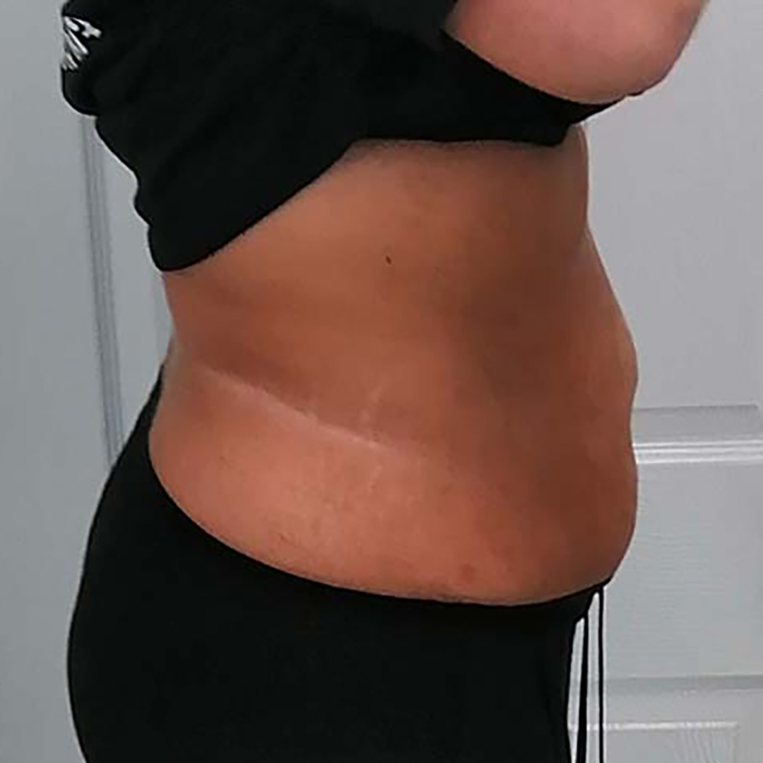 Before Lippo Slimming