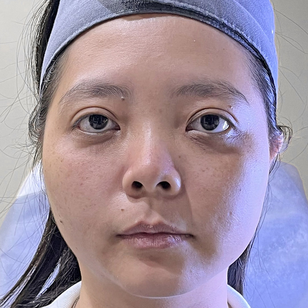 Before Juvelook Under Eye