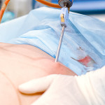 Ultrasound Vaser Lippo Selection