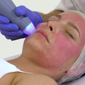 Exion RF Microneedling