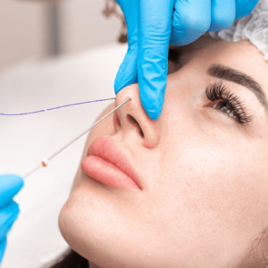 Nose Threadlift