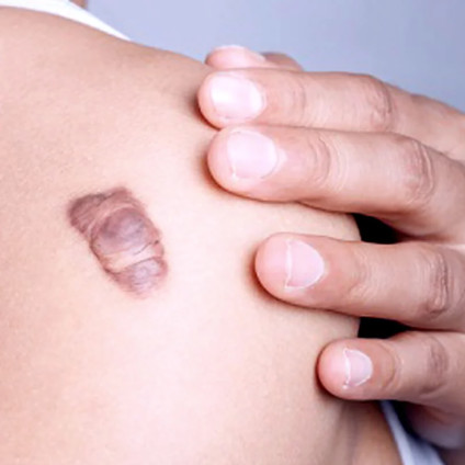 Suntik Keloid