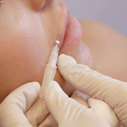 Lip Threadlift