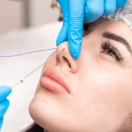 Nose Threadlift