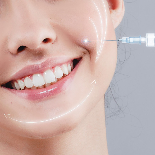 Juvelook Smile Line