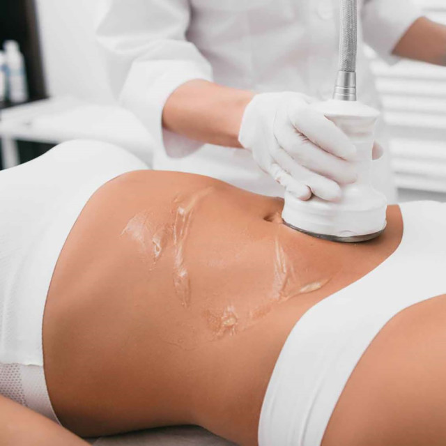 RF Cavitation