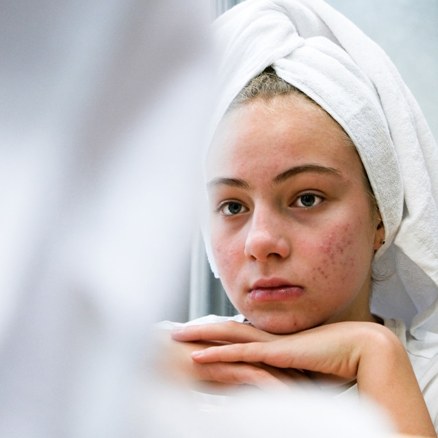 Acne Clear Injection