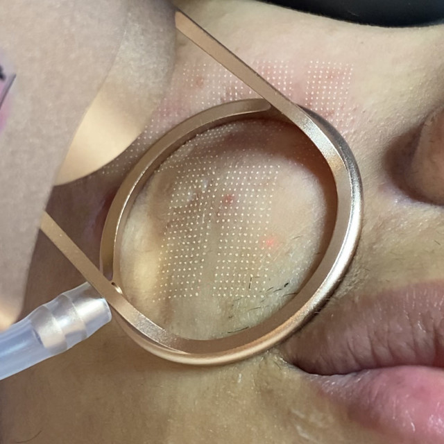 Fractional Laser