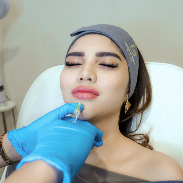 Filler Bibir